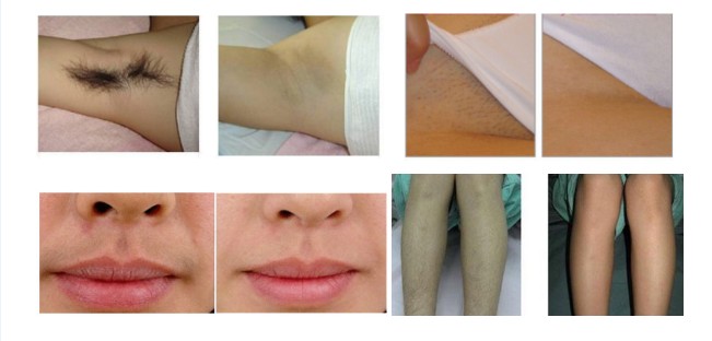 808 Laser Diode Hair Removal Beauty Device Low Price