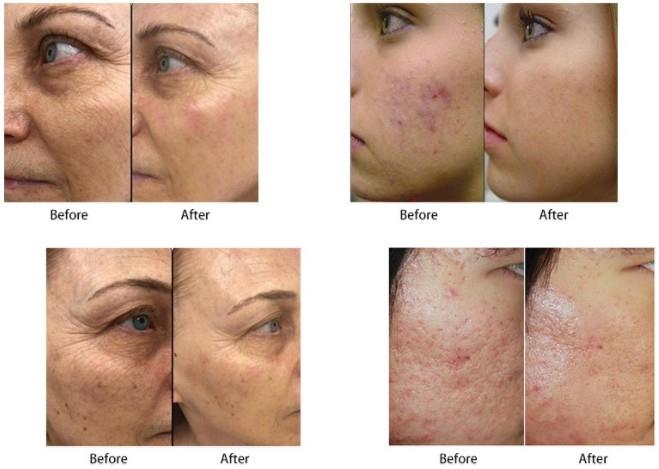 Vertical Fractional Rf Microneedle Scarlet Special Fractional Magic Effect Face Lift