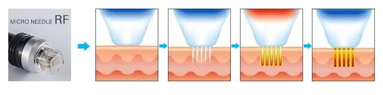 Microneedle Rf Radio Frequency Machine Microneedle Rf And Fractional Rf Sanhe Beauty Machine For Face Lift