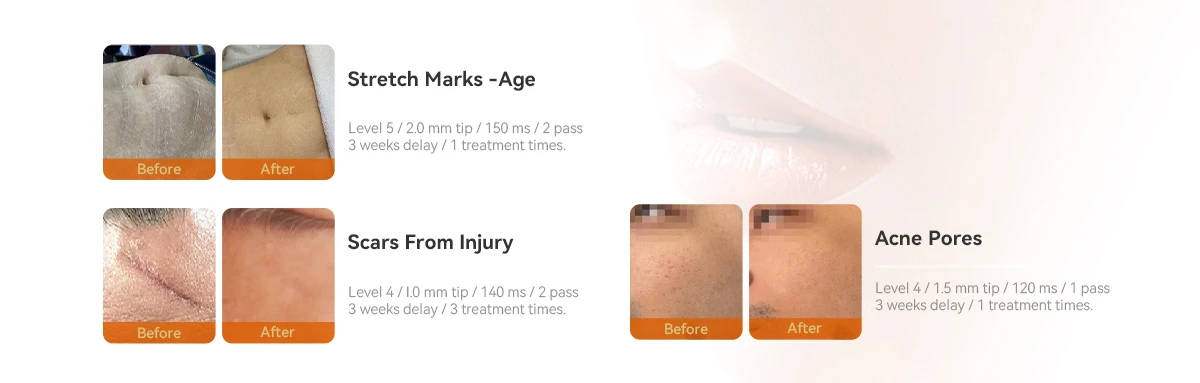 Newest Vacuum Microneedle Rf Machine Newest Vacuum Microneedle Rf Machine